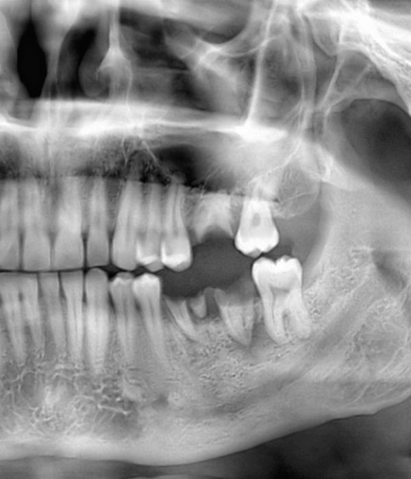 Dental x-ray showing severely damaged teeth