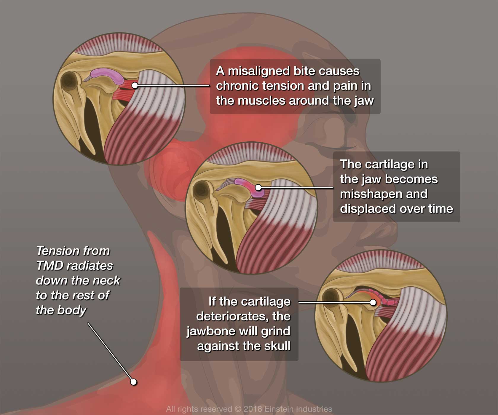 illustration of TMJ disorder
